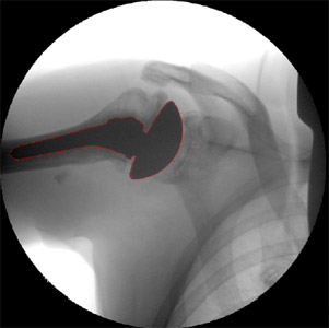 Biomechanics Figure 13 Typical fluoroscopic image of the shoulder with TSA after being automatically segmented and manually adjusted for ancillary outlines.