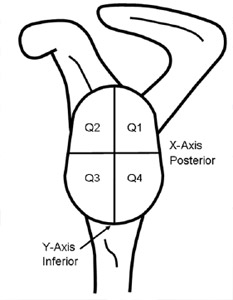 Biomechanics Figure 15 Left scapula shown with glenoid component. Cartesian coordinate system is created with the origin at the geometric center of the component.