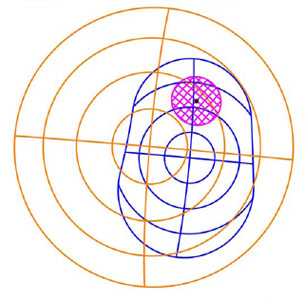 Biomechanics Figure 19 The overlap area of the humeral head and glenoid component is shown in pink. The black point is the centroid of the pink contact area.