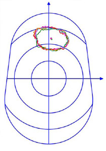 Biomechanics Figure 20 Digitized voided silicon area on the glenoid component.