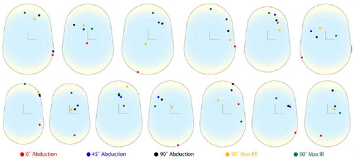 Biomechanics Figure 21 Unscaled patient specific contact locations on the glenoid surface as a function of arm position, shown by color code. All right shoulder contact locations were mirrored to left glenoid components.