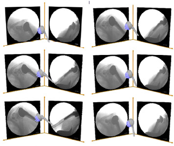 Biomechanics Figure 27 A virtual dual plane fluoroscopic imaging system with TSA components in an abduction / adduction animation sequence. The cycle begins in the top image with a humeral abduction of 28° to the vertical, peaks in the third image at 55° and ends with the bottom image at 23°.