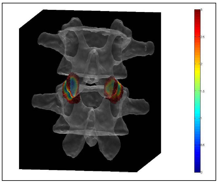 Figure 34: ROI Distance Map Superimposed On Transparent Vertebral Bodies fig 34
