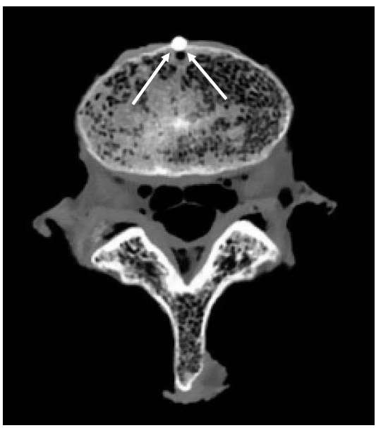 Figure 35: Aluminum Fiducial Results in Low Artifact in CT fig 35