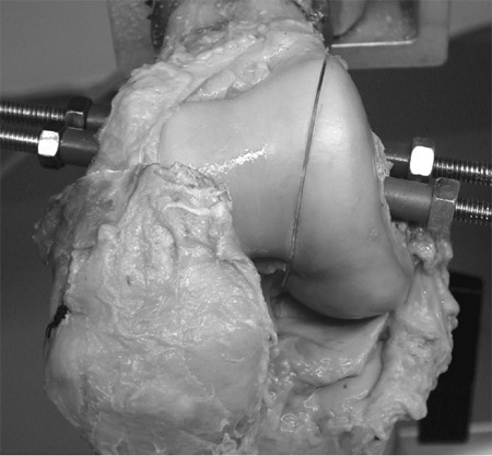 lateral femoral