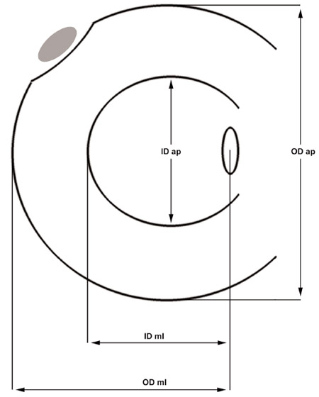 Figure 3. Measurement of the original lateral menisci and
lateral meniscal transplants. OD, outer diameter; ID, inner
diameter; ml, mediolateral; ap, anteroposterior. Measurement of the original lateral menisci