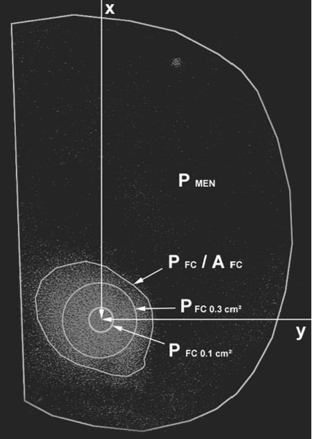 Figure 7. Measurement parameters on the pressure-sensitive
films. AFC, femorotibial contact area; PFC, mean femorotibial
contact pressure; PFC0.3cm² and PFC0.1cm², peak pressures of the
femorotibial contact; x and y, location of the maximum pressure
(arrows); PMEN, mean meniscotibial pressure. measurement parameters
