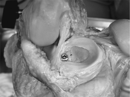 meniscal transplant