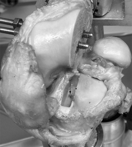 Figure 2. Cement box preparation for implantation of the original
lateral meniscus and lateral meniscal transplants. The lateral
rim of the box was bounded by the tip of the lateral tibial
eminence (black mark). A thread was cut into the bottom of
the box for screw fixation of the bone block (arrow). preparation for implantation
