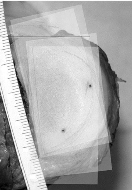 Figure 6. Graphical superimposing of the film scans on a digital
picture of the tibial plateau using the marker tunnels of
the plateau and corresponding dots on the films. tibial plateau