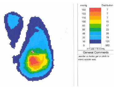 Podiatry Figure 3. Pressure distribution map of a wheelchair. This graph show the pressure exerted by a subject sitting on a wheelchair. It has been measured using a thin, flexible pad and can be read using a computer (Pressure Sores, 2003).