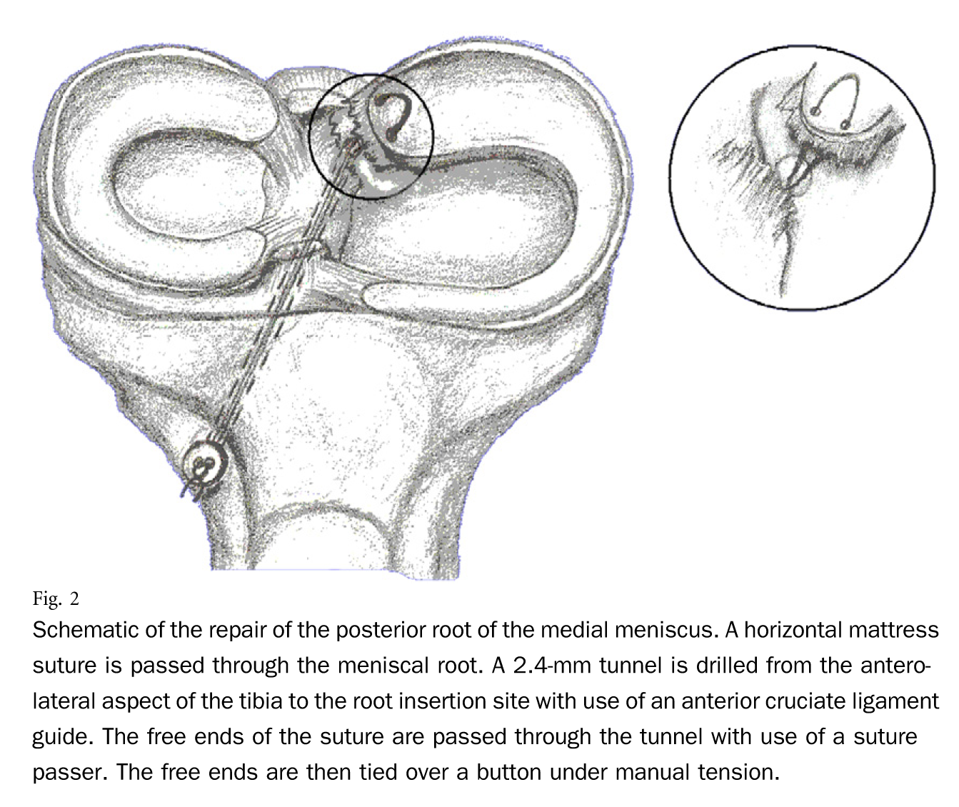 repair-of-the-posterior-root