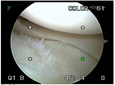 Arthroscopic photograph of the lateral compartment of the knee